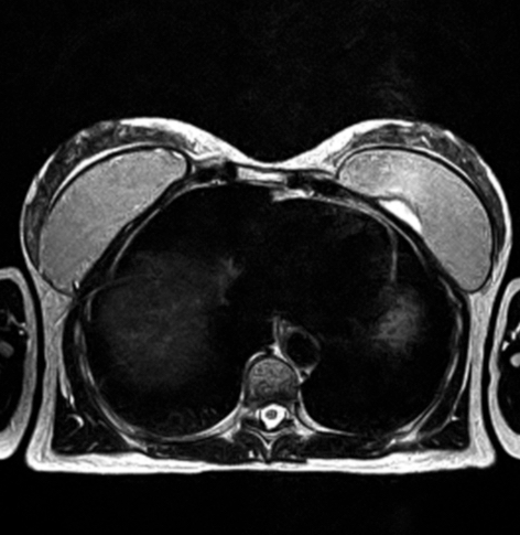 Breast Implants MRI scan